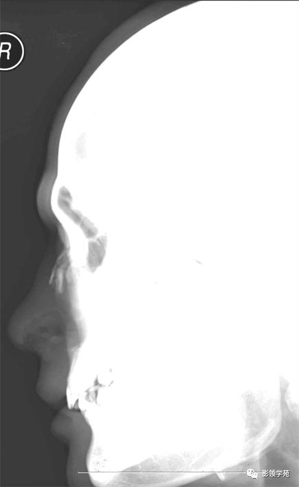 鼻骨影像学解剖,鼻骨解剖及骨折影像学诊断