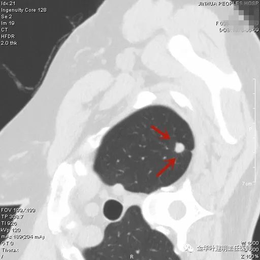 叶建明谈实性结节,叶建明肺实性良性结节会变癌症吗