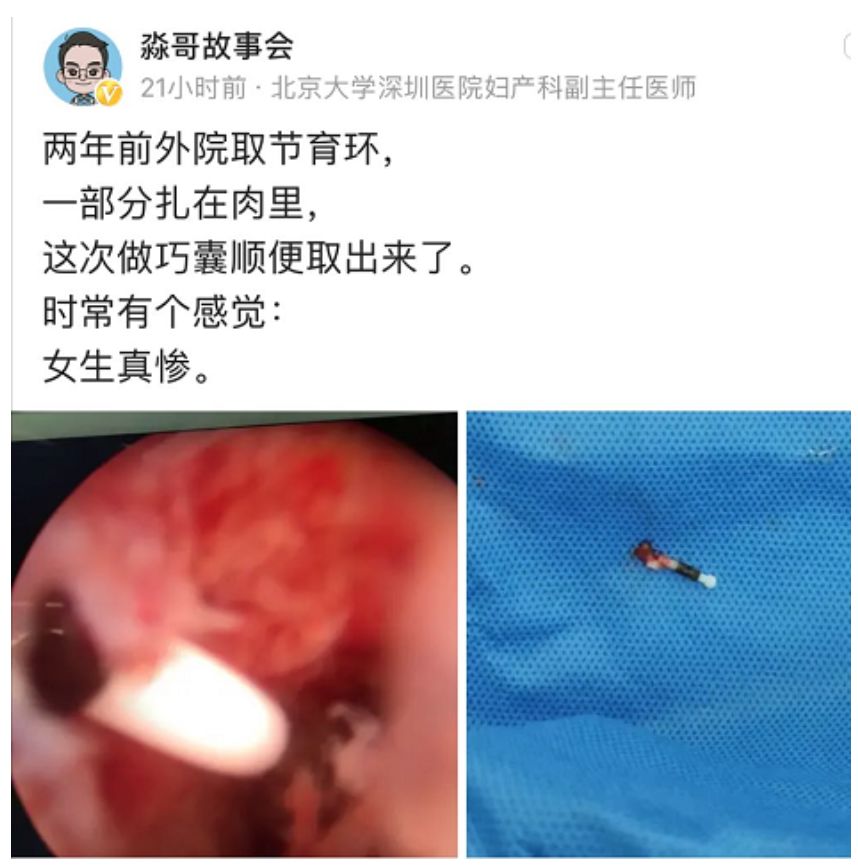 美国男性结扎人数,美国男性为什么扎堆结扎