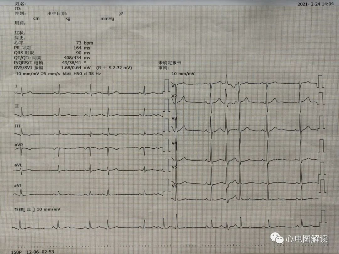 房性早搏有时伴心室内差异性传导,房性早搏与反复搏动区别