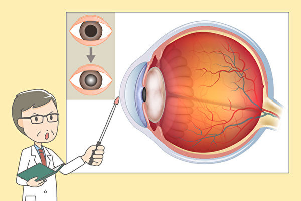 白内障怎么预防和保养,失明怎么可以预防