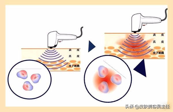 热玛吉水光针皮秒光子嫩肤原理,水光针光子嫩肤哪个美白