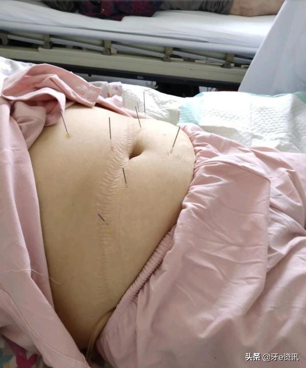 环湖医院穿刺治疗脑干出血,脑干出血3ml后脑水肿会有几天