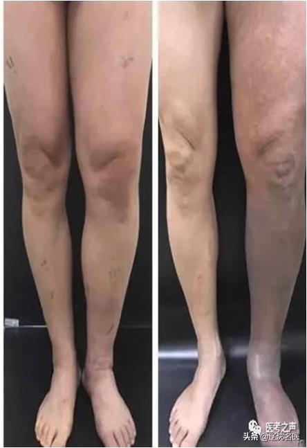 一条腿上血栓可怕吗,有一种血栓治不好