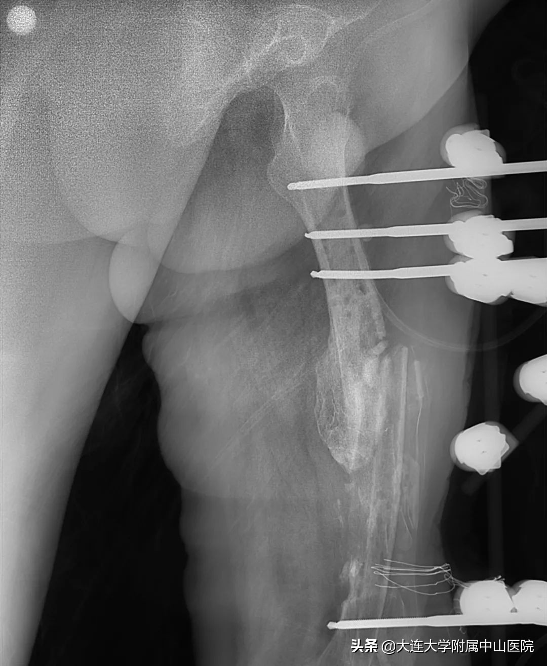 迁延性骨髓炎,慢性骨髓炎最终结局