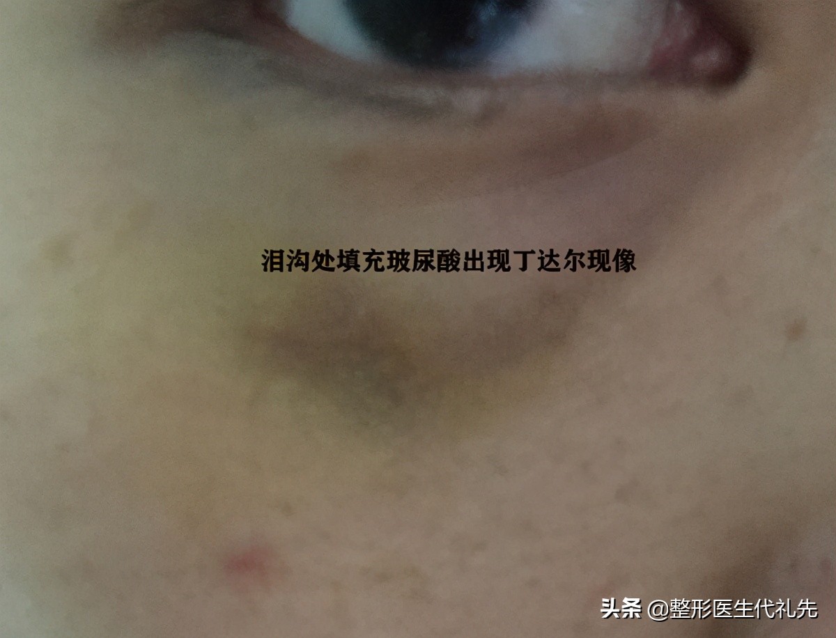 眼袋泪沟填充用什么方法最好,泪沟填充多了像眼袋怎么办