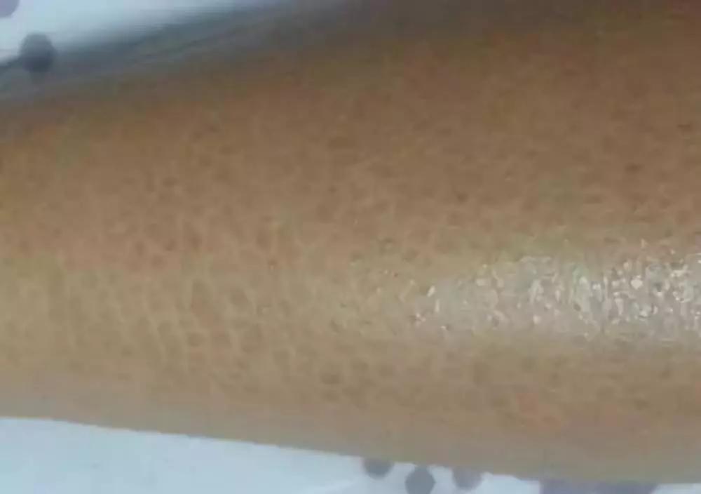 鸡皮肤救星香皂,鸡皮肤专用皂