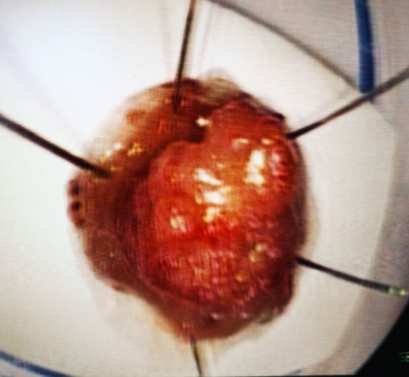 肠息肉切除手术危险,恶性肠息肉做微创一般住院几天