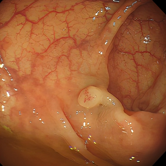 胃肠息肉是癌吗,长了结肠息肉会有什么症状