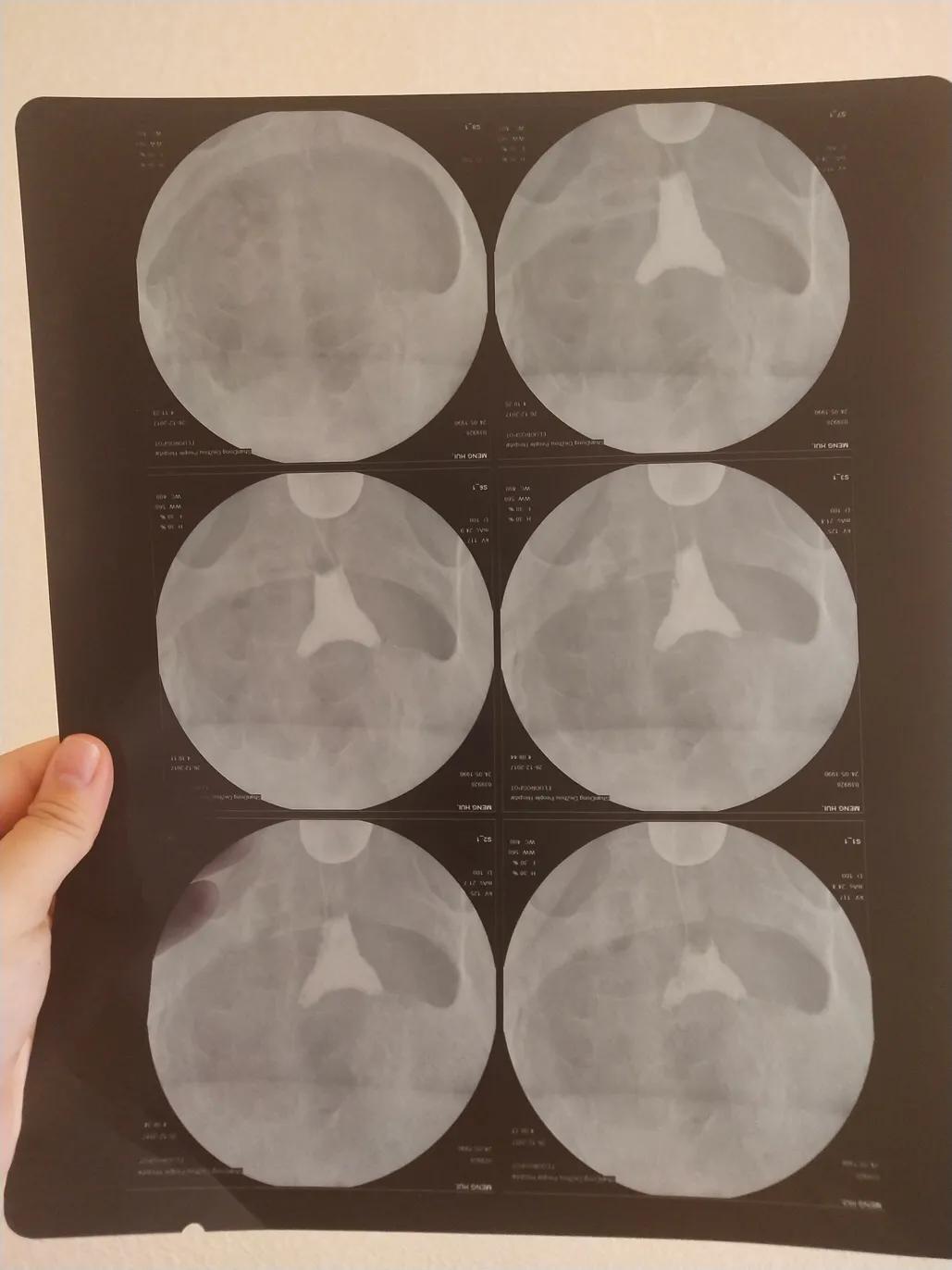 双侧输卵管不通自然怀孕了,双侧输卵管通而不畅能自然怀孕吗