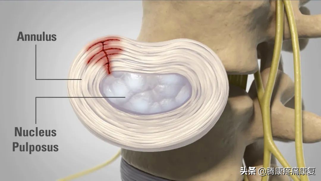 腰椎间盘退行性改变怎么治疗呢,腰椎退行性变和腰间盘突出哪个重