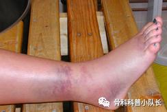 崴脚超过24小时是热敷还是冷敷,崴脚超过48小时是热敷还是冷敷