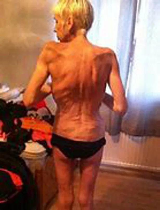 朋友圈卖的这种网红*肥药减**竟是*品毒**？想瘦的姑娘们，别再拿命赌了