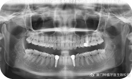 厦门种植牙陈松福,口腔正畸案例分享