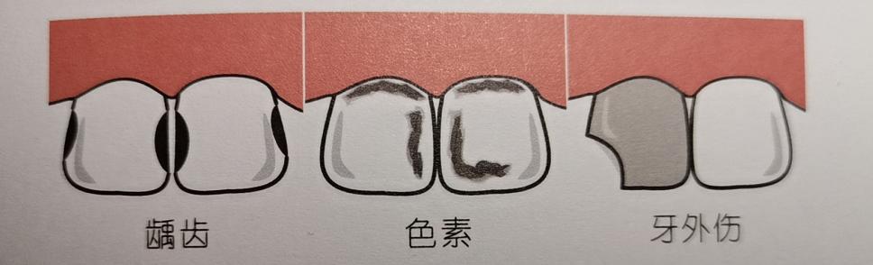 宝宝门牙发黑怎么根管治疗,宝宝门牙变黑是什么原因