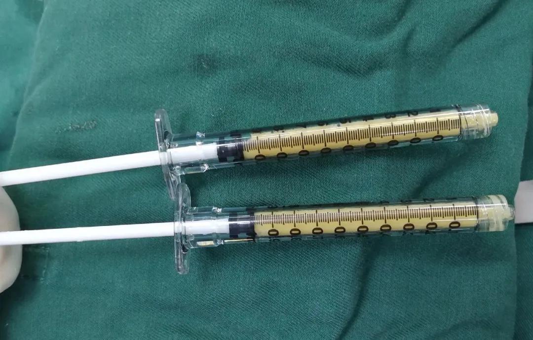 自体脂肪填充全脸逆袭,自体脂肪填充的真相来了