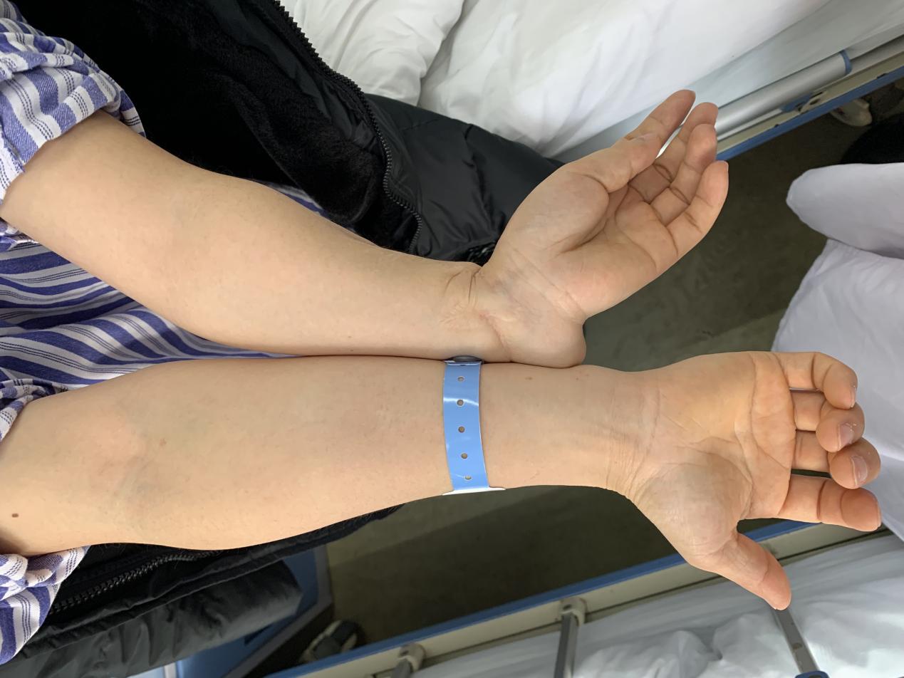 爬树跌倒骨折敷草药误事竟致手部严重畸形20年