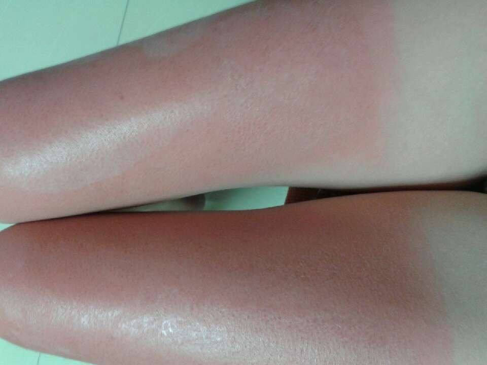 阳光浴严重晒伤怎么办,晒伤怎么预防