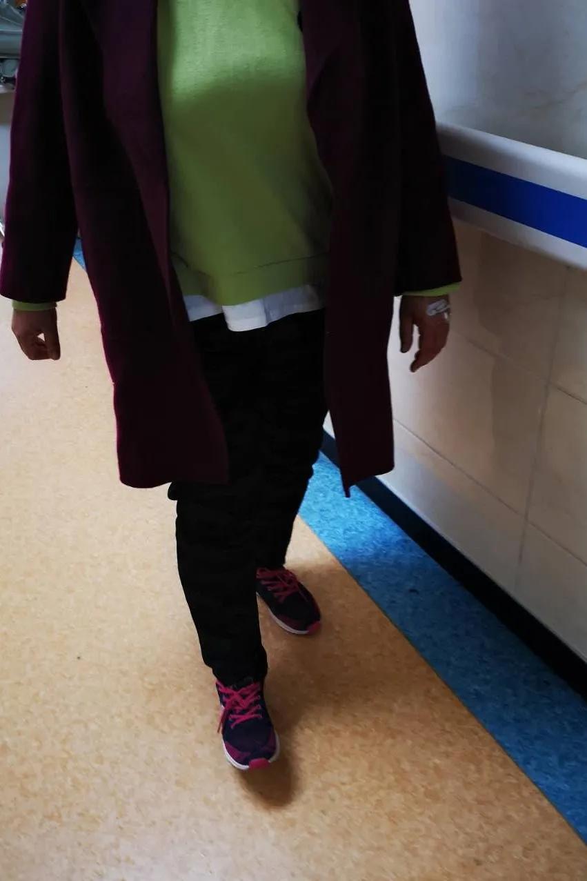 河北静脉曲张微创手术,邢台静脉曲张手术多长时间治好