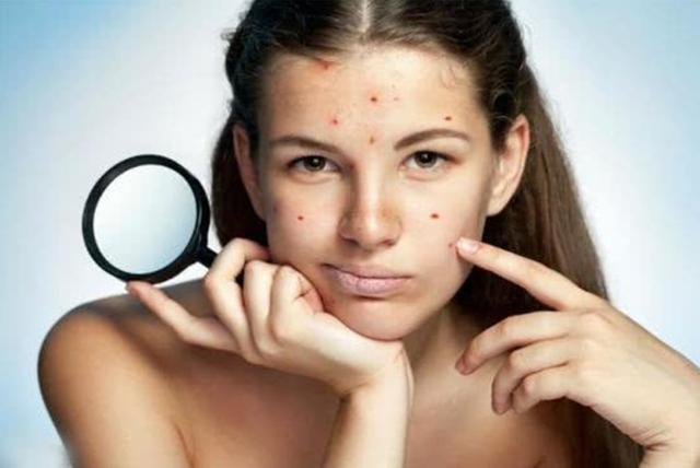 痘痘怎么治都不好不洗脸却好了,痘痘怎么治疗才能彻底治好
