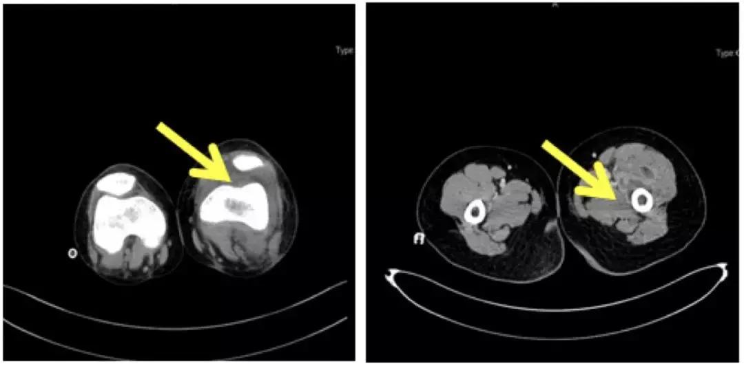 万古霉素治疗mrsa疗程,万古霉素用于mrsa的作用机制