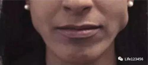 瘦脸针可以解决发腮的问题吗,关于瘦脸针的那些黑幕你听说过吗