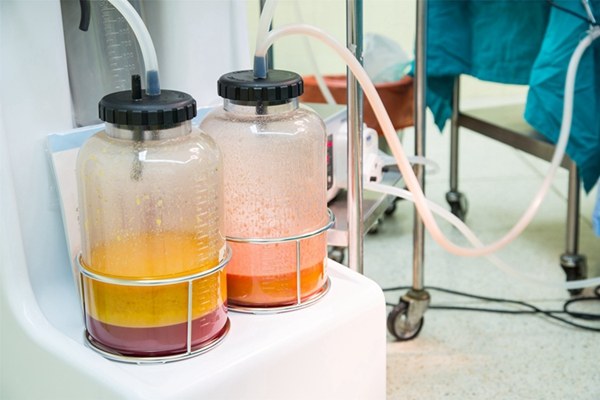 抽脂成为当下女性减肥潮流,抽脂减肥:想怎么瘦,就能怎么瘦?