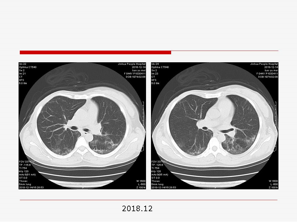 像炎症的肺癌能治好吗,医生说可能是肺癌也可能是炎症