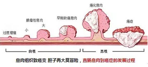 息肉是癌细胞还是痔疮,息肉是肿瘤的一种吗