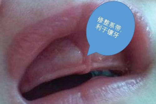 牙齿缺失,需要及时镶牙,口腔医生:镶牙前需要做这些准备工作