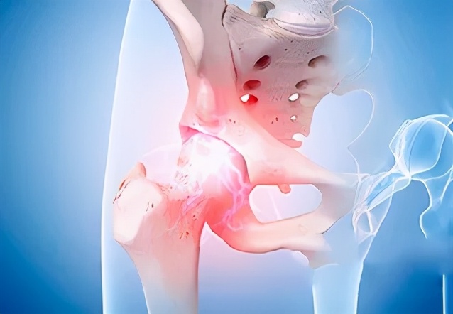 股骨头无菌坏死与什么混淆,科普股骨头坏死的原因及治疗方法