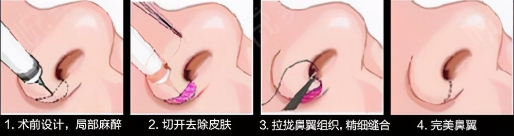 鼻子整形难看吗,鼻子丑只能整吗