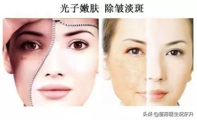 光子嫩肤果酸换肤水光针顺序,皮秒和光子嫩肤的区别效果对比