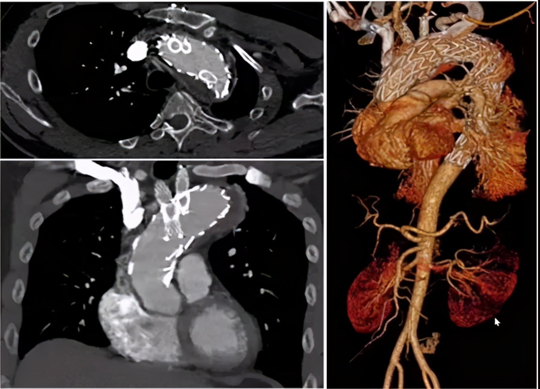 胡佳:升主动脉近端手术后新发弓部病变的腔内治疗