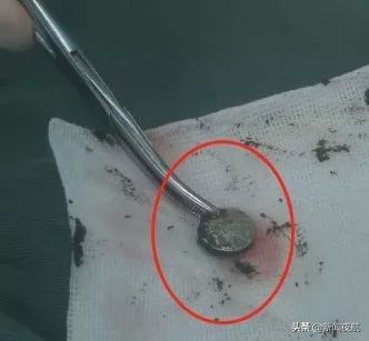 孩子鼻子塞进异物抠出来后流血,小孩被异物插进鼻子流血怎么办