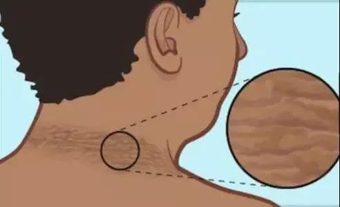 不是“脏”!孩子脖子一圈黑,妈妈用清洁球都擦洗不掉……