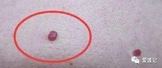 皮肤出现了很多小红点,皮肤上的小红点是怎么回事