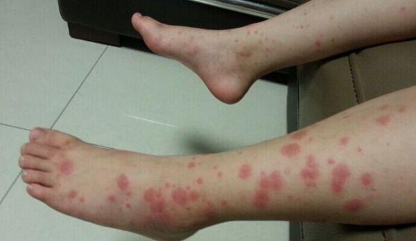 8岁小孩脚有点肿会是肾病吗,小孩双下肢皮疹