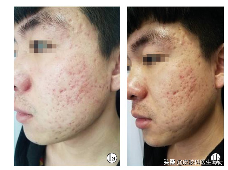 长痘了挤了留了坑怎么办,痘没了留下个疙瘩怎么回事