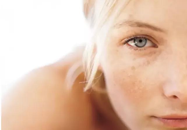 炎症后的色素沉着恢复过程,面对疾病积极治疗坚强勇敢