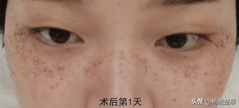 皮秒会反黑吗,皮秒反黑可以继续做皮秒吗