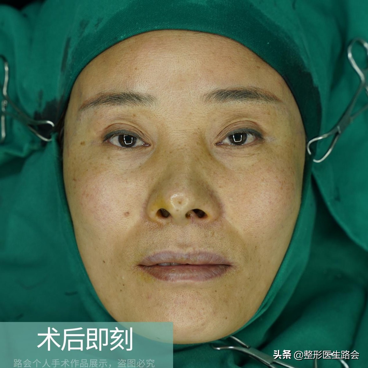 脂肪填充太阳穴哪家医院可靠,脂肪填充太阳穴成活率高不高