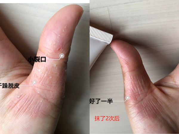 冬天脚后跟干裂用什么润脚霜,润足脚后跟干裂修复霜