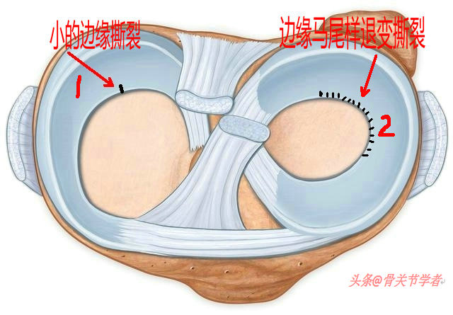 磁共振图片讲解半月板损伤的程度,磁共振半月板损伤严重