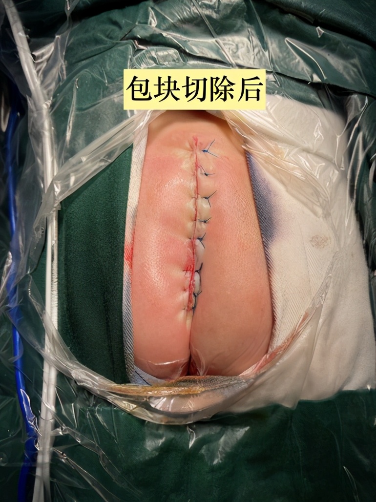 脊柱裂脊髓栓系手术恢复过程,脊柱裂与脊髓脊膜膨出的区别