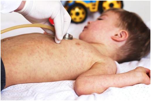 孩子打了疫苗为什么还会得结核病,小孩打了麻疹疫苗为啥还起麻疹