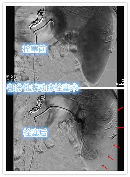 脾功能亢进导致血小板减少怎么办?