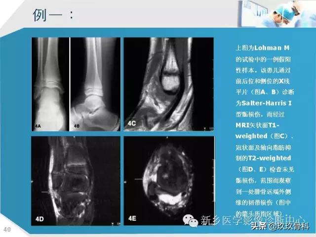 骨骺损伤x线表现,骨骺损伤磁共振表现