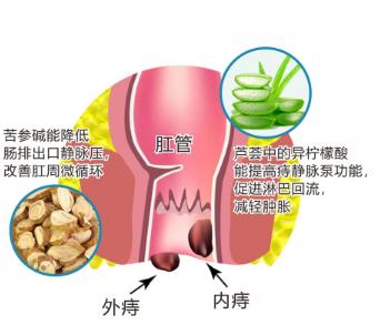 得痔疮必须要做手术吗,得了痔疮有必要做手术吗