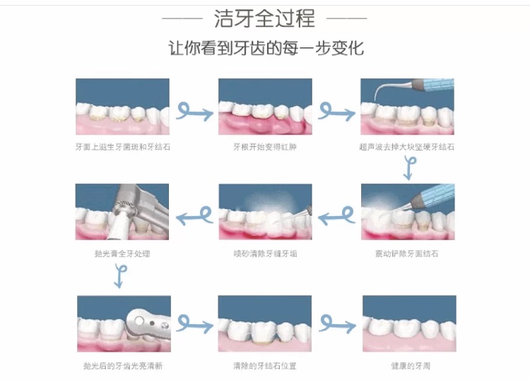 洗牙损伤牙齿别听牙医忽悠,洗牙把黑线洗掉有危害吗